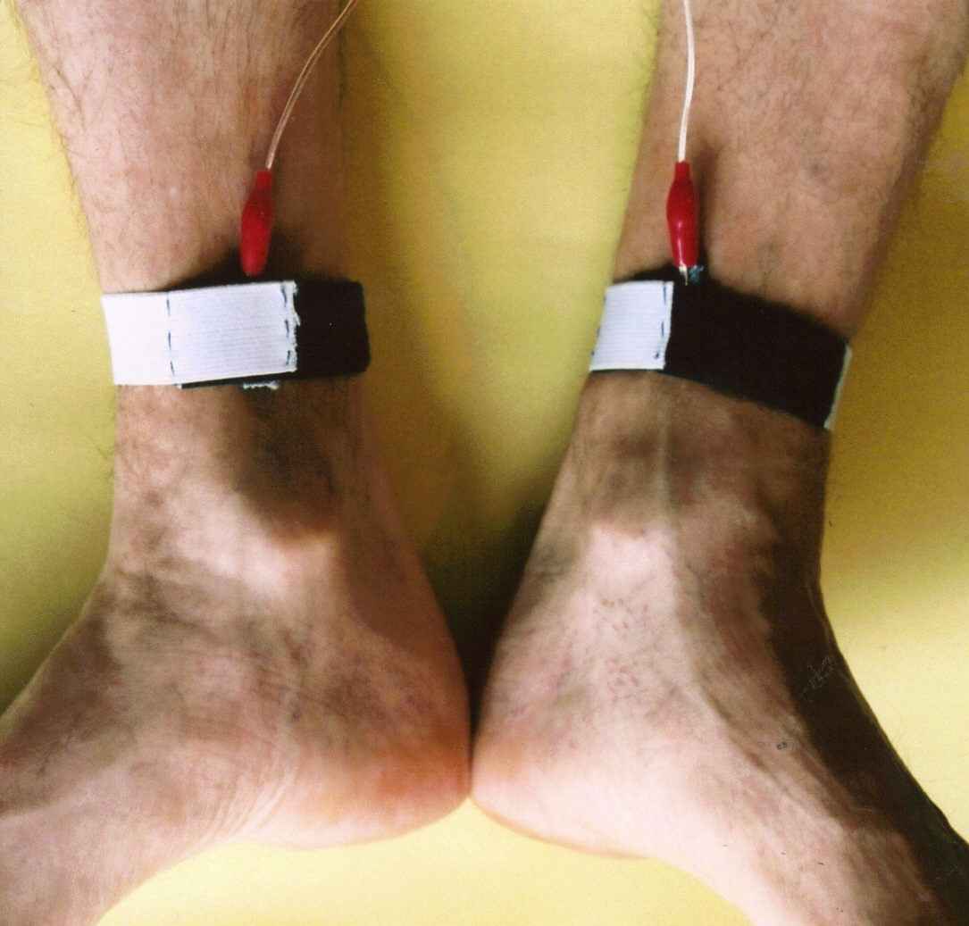 picture of electrodes attached to ankles